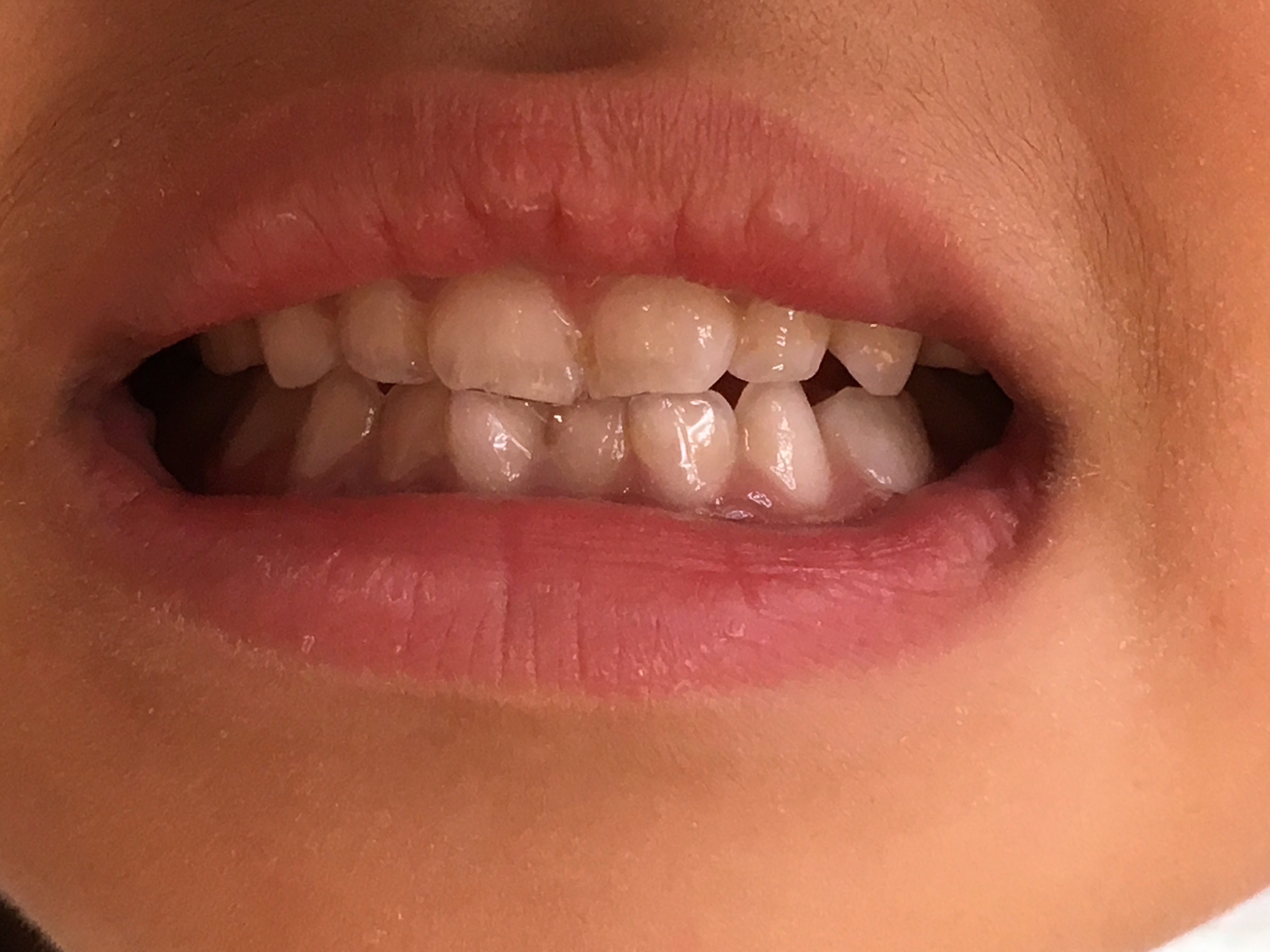 赤ちゃん 前歯 上の歯 すきっ歯 263899赤ちゃん 前歯 上の歯 すきっ歯